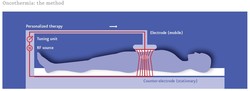 regional hyperthermia:  the method, Medical Center Frankfurt, germany